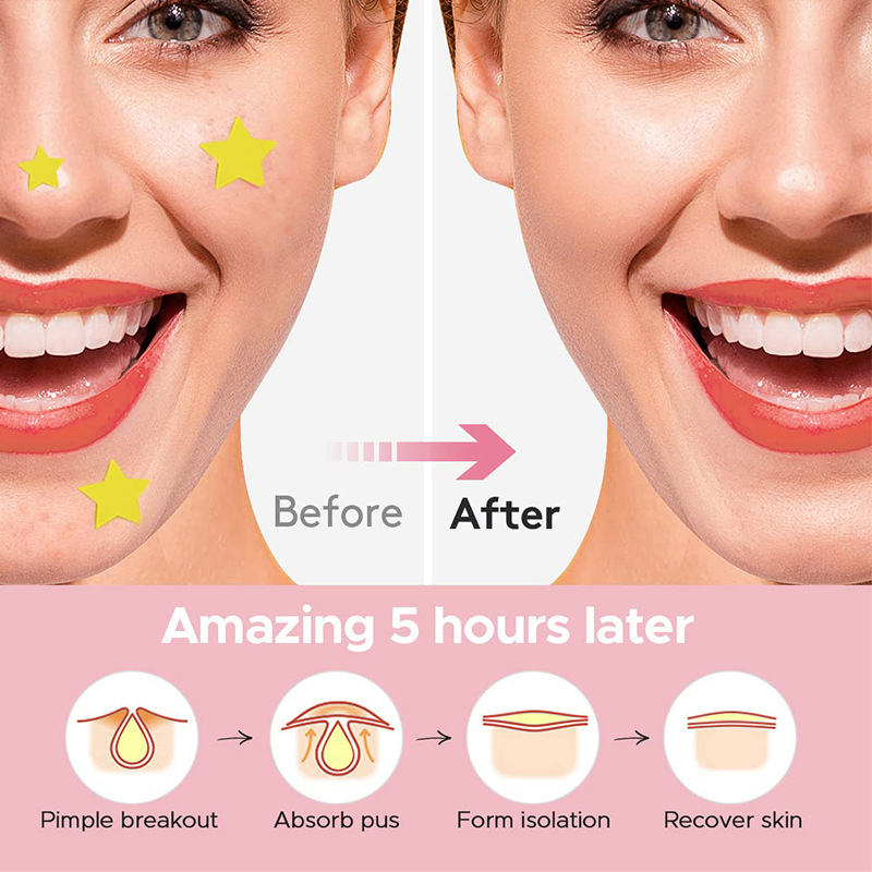 600Pcs/set Plester Jerawat Bin - Beauty With Makeup ulasan dan harga